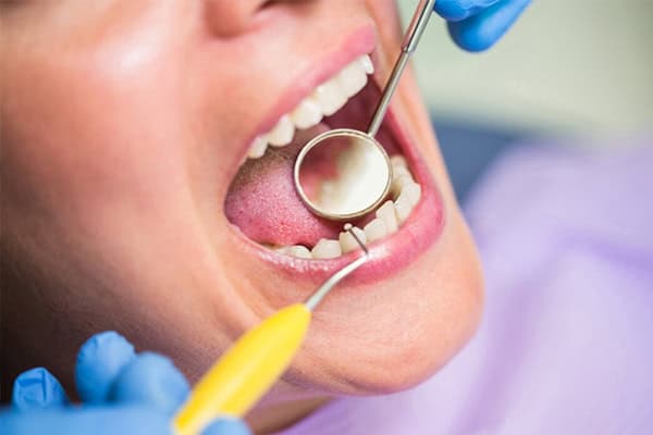 Amalgam Fillings Newark,DE