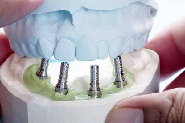 Implant Retained Dentures Newark,DE