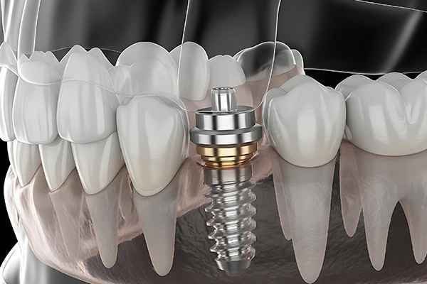 Implant Retained Crowns & Bridges in Newark,DE
