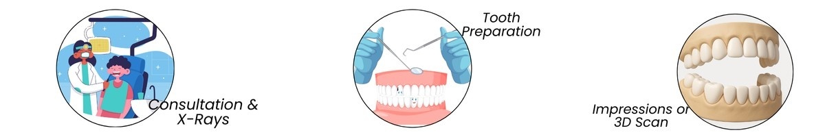 Step-by-Step Dental Bridge Procedure | Main Street Dental
