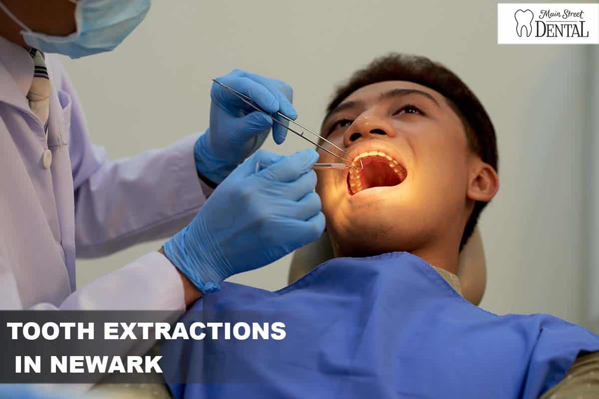 Tooth Extractions in Newark, Delaware