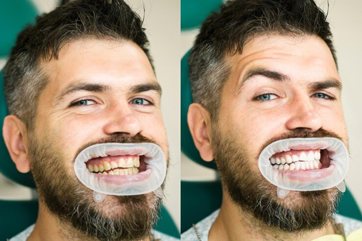 Teeth Whitening Before and After by Main Street Dental Newark, DE