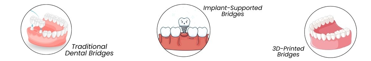 Types of Dental Bridges&nbsp;| Main Street Dental