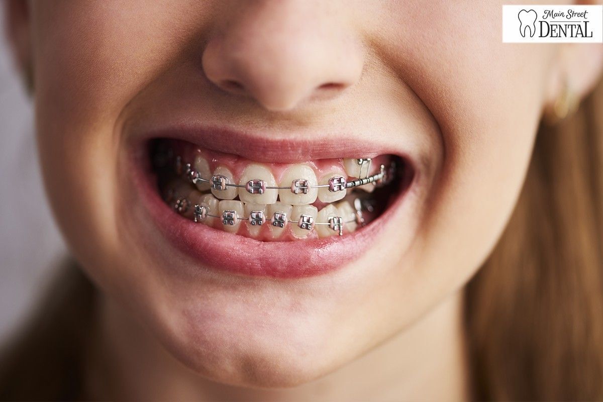 Understanding the Costs of Braces Today | Main Street Dental