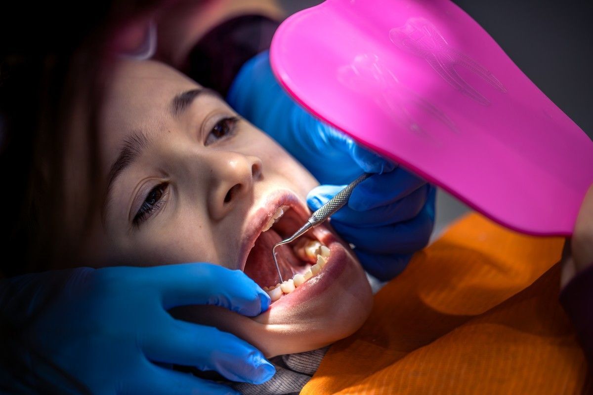 Do Fillings Cause Tooth Decay Underneath the Fillings?