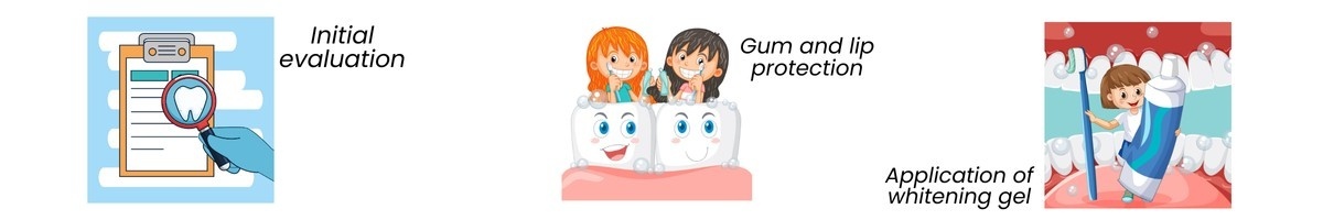 What Is Professional Teeth Whitening?