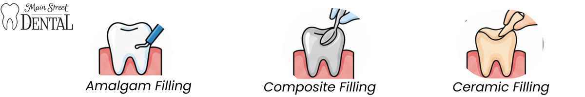 Types of Dental Fillings